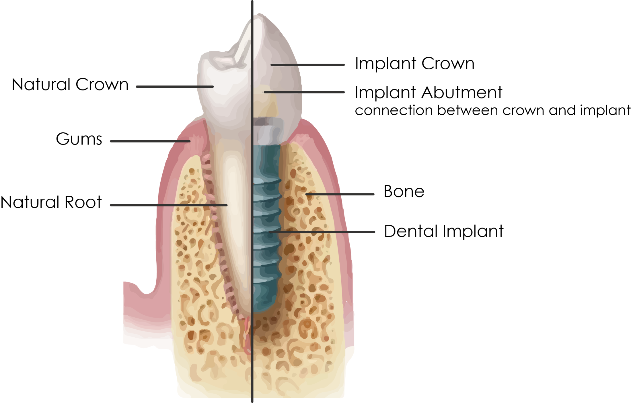 Dental Implants Knoxville TN | What Are Dental Implants